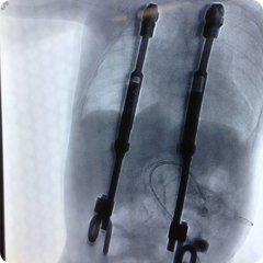 X-ray showing Evey's VEPTR device. 